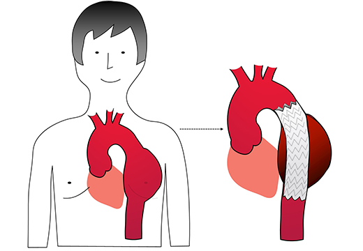 大動脈瘤手術のイメージ