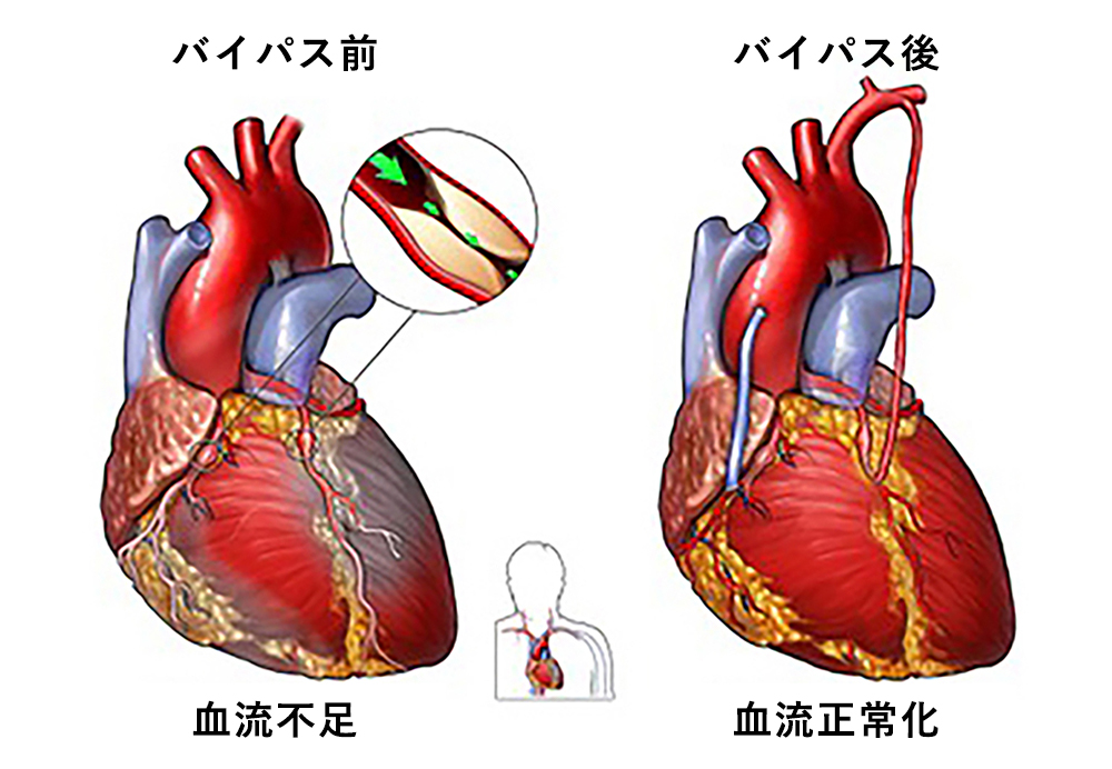 冠動脈バイパス手術のイメージ1
