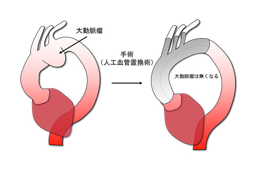 人工血管置換術のイメージ