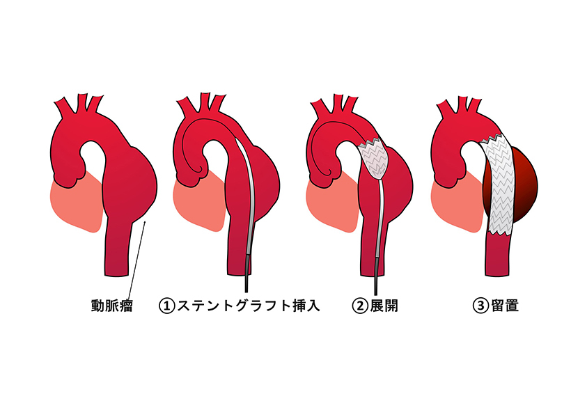大動脈瘤手術のイメージ